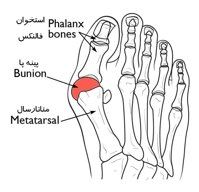 پینه پا چیست