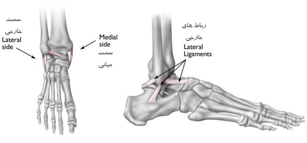 پیچ خوردگی مچ پا