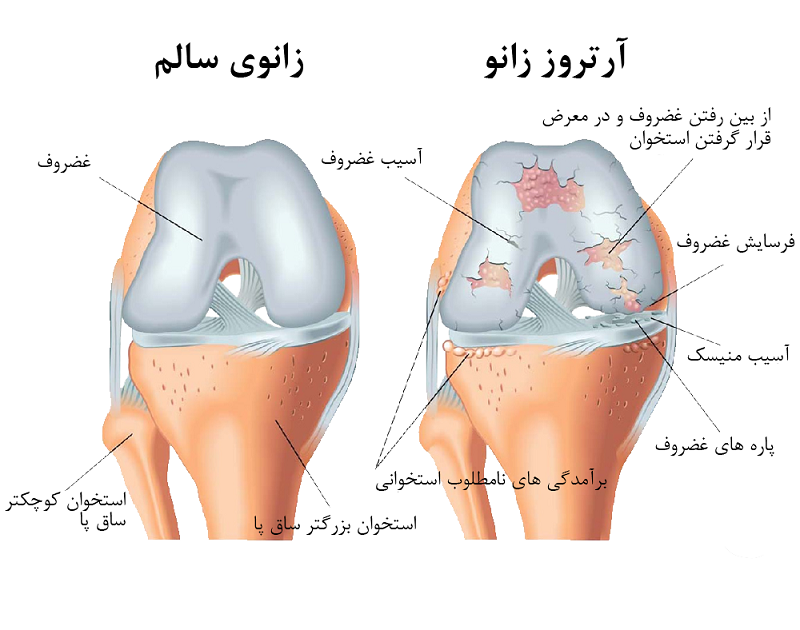 آرتروز زانو