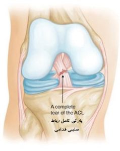 پارگی نسبی رباط صلیبی قدامی (ACL)