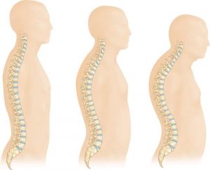 علل شکستگی ستون فقرات