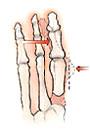 استئوتومی