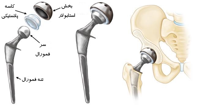 تعویض کامل مفصل ران