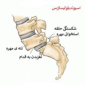 مهره لغزیده