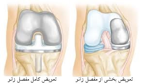تعویض مفصل زانو