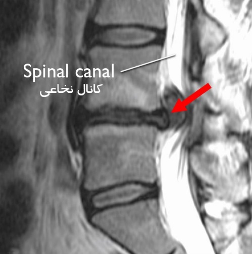 ام آر آی بیرون زدگی دیسک کمر