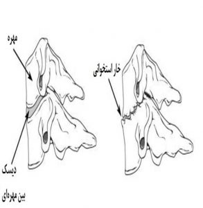 فرسایش یا تخریب دیسک و خار استخوانی