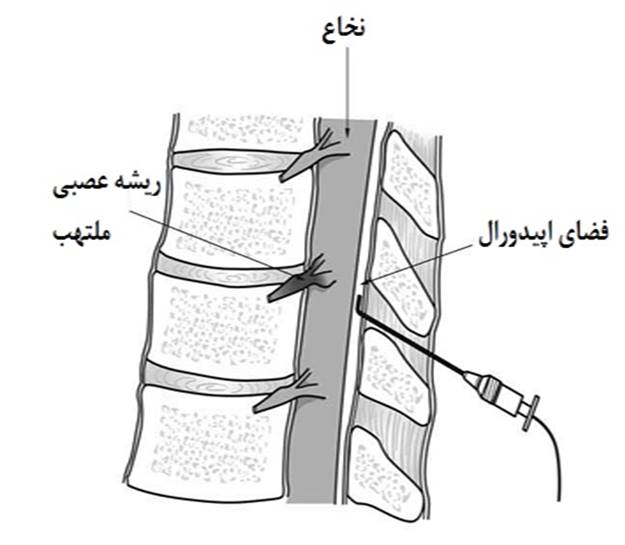 تزریق اپیدورال در ستون فقرات گردنی