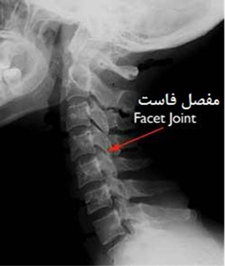 عکس رادیولوژی از یک مفصل فاست گردنی