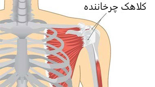 رسوب کلسیم و ورم حاد کلاهک چرخاننده