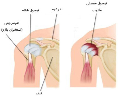 شانه منجمد یا کپسولیت چسبنده