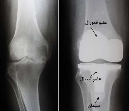 عکس رادیولوژی زانو