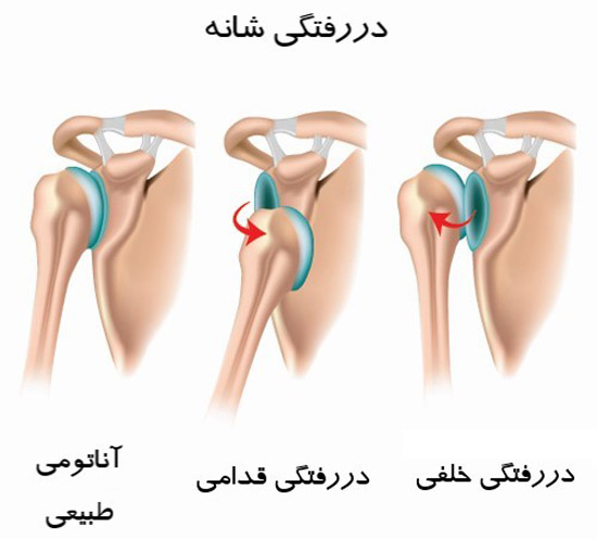 دررفتگی مفصل شانه