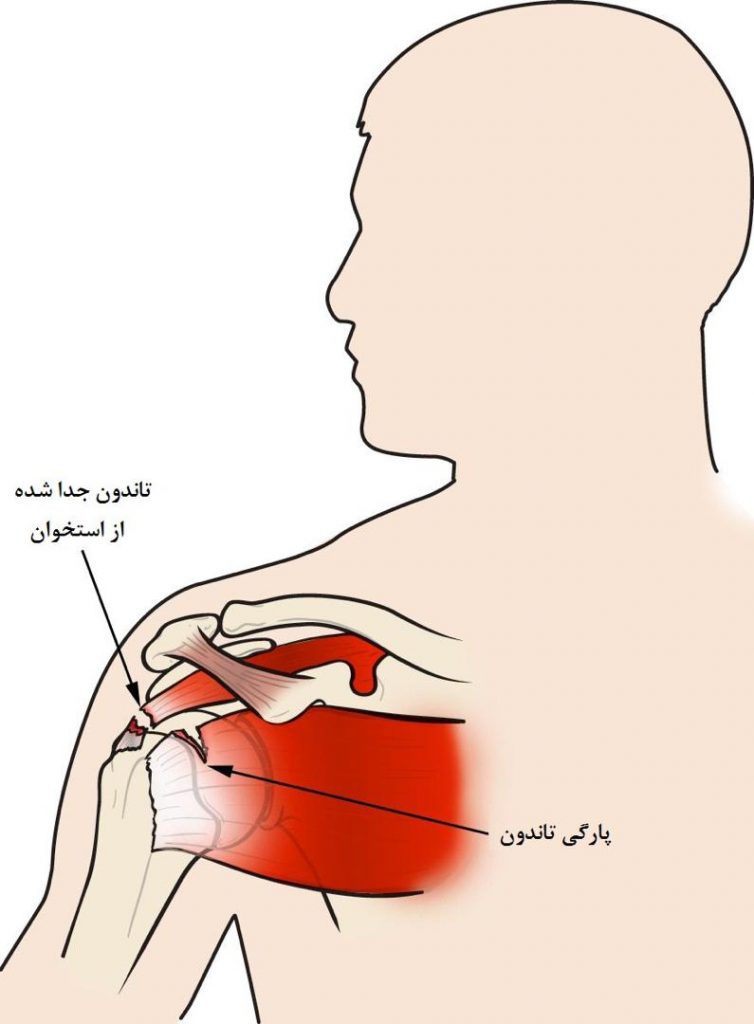 ساختار (آناتومی) شانه شما از سه استخوان تشکیل شده است: استخوان بازو (Humerus)، تیغه شانه (استخوان کتف)، و استخوان یقه (استخوان ترقوه). شانه یک مفصل گوی و حفره (سوکت) است: گوی یا سر استخوان بازو (استخوان هومروس) در حفره (سوکت) کم عمق تیغه شانه فیت میشود.