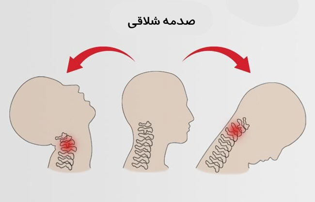 صدمه شلاقی گردن