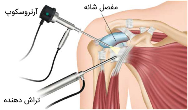 آرتروسکوپی شانه