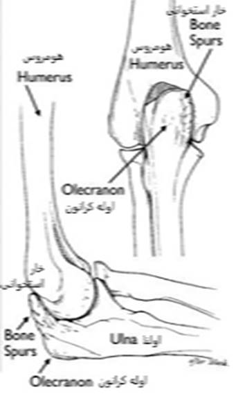 اضافه بار کشش والگوس