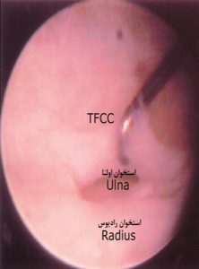 آزادسازی تونل کارپال