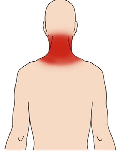 علائم رگ به رگ شدن گردن