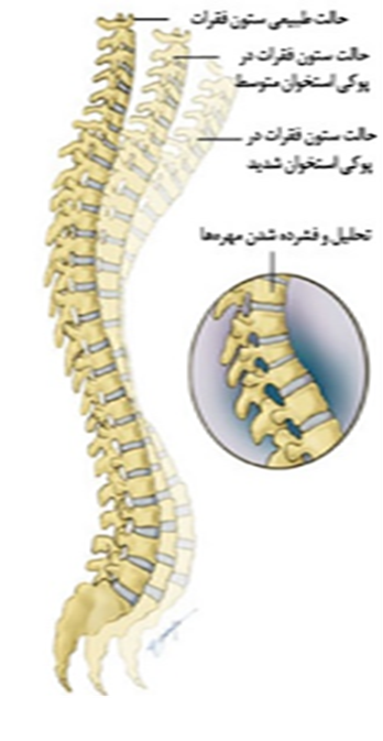 مصرف کلسیم و پوکی استخوان