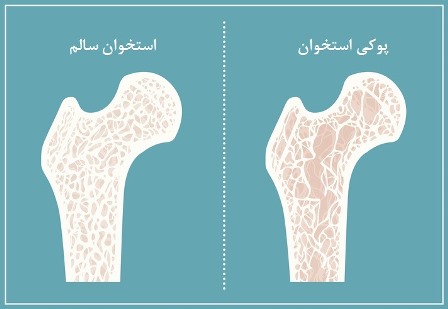 پوکی استخوان چیست