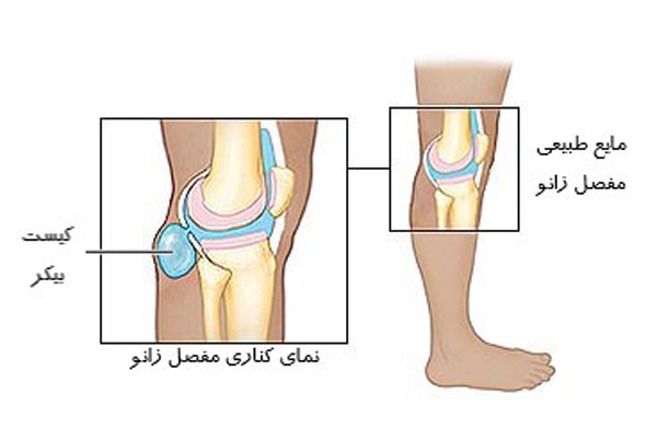 کیست بیکر (Baker's cyst)