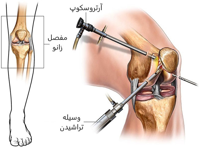 آرتروسکوپی زانو