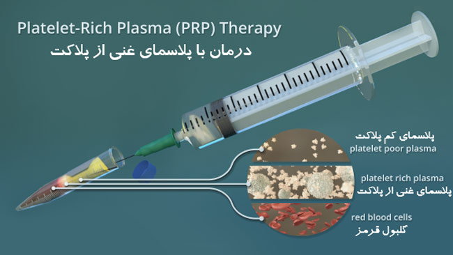 تزریق PRP برای درمان زانو درد