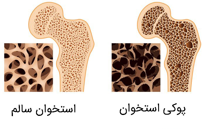 علل پوکی استخوان