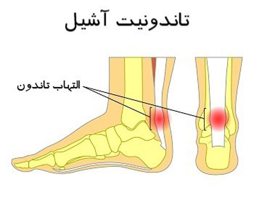 تاندونیت آشیل