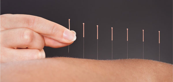طب سوزنی برای مدیریت درد