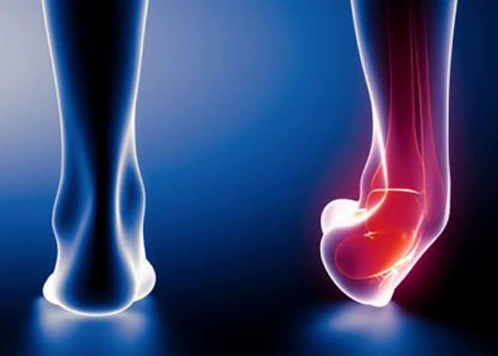 پیشگیری از پیچ خوردن مچ پا