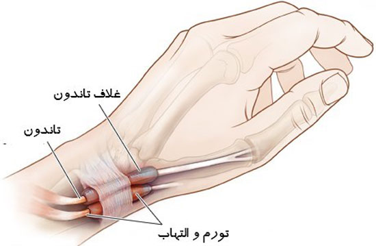 تنوسنوویت دکوروین