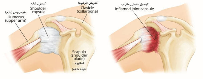 مراحل شانه یخ زده