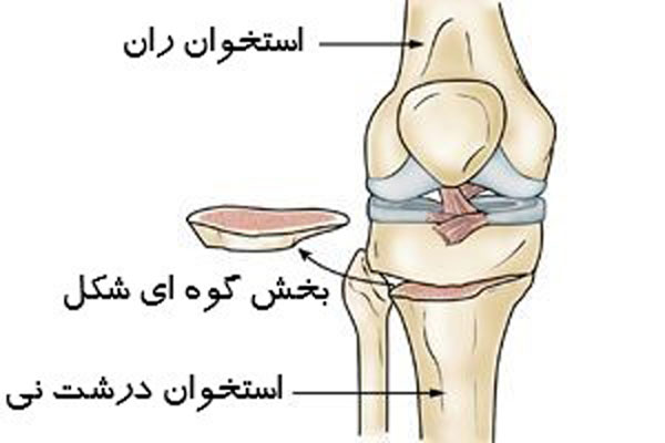 استئوتومی زانو
