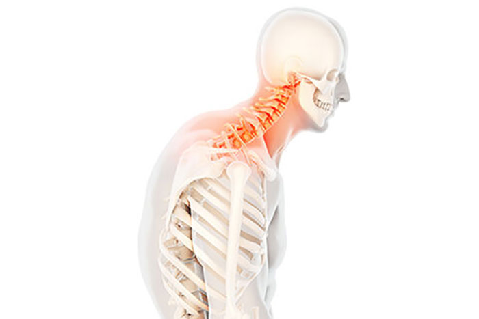 کیفوز یا گوژپشتی چیست