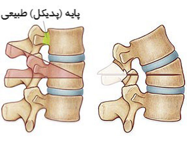 استئوتومی برداشتن پایه استخوانی (پدیکل سابتراکشن)