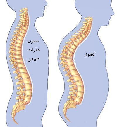 کیفوز یا گوژپشتی