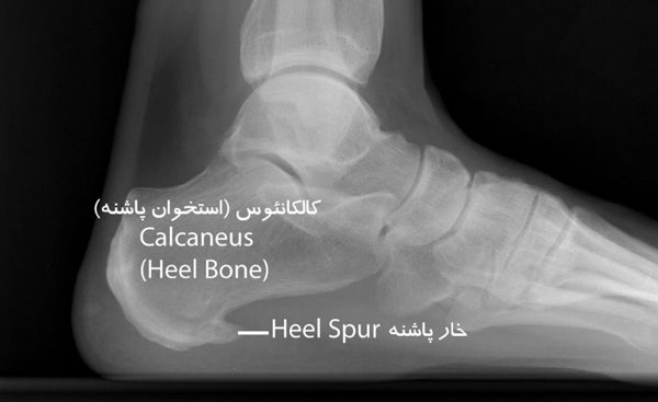 خار پاشنه