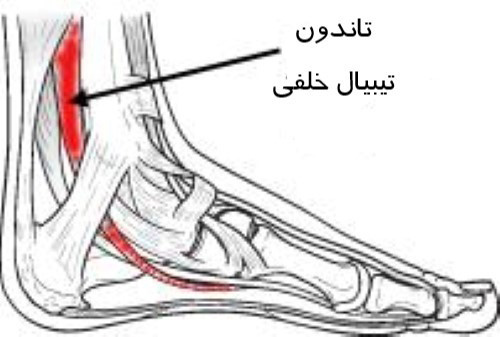 اختلال عملکرد تاندون تیبیال خلفی