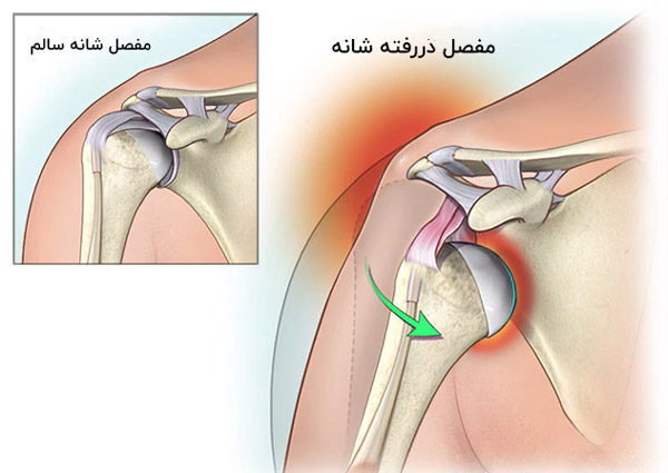درمان دررفتگی شانه