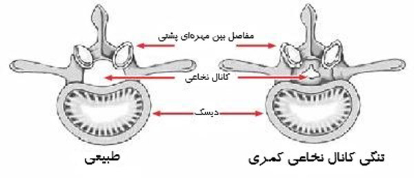 تنگی کانال نخاعی