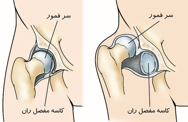 دررفتگی یا دیسپلازی مادرزادی مفصل ران