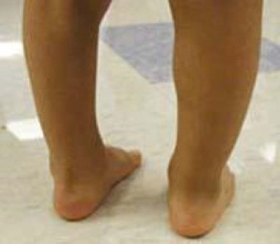 درمان پا چنبری