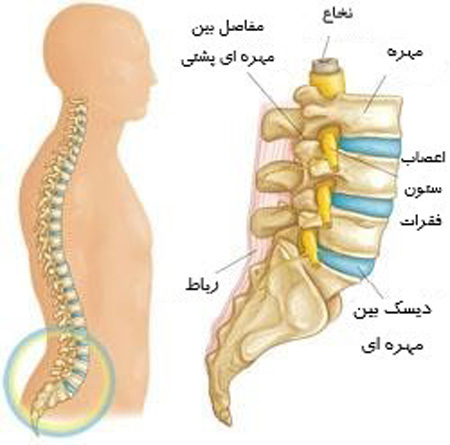 درد سیاتیک
