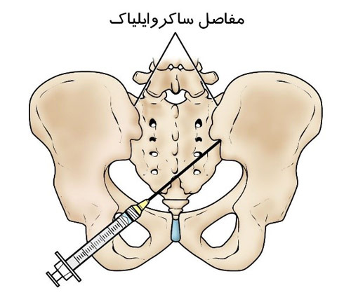 تزریق مفصل ساکروایلیاک درون لگن