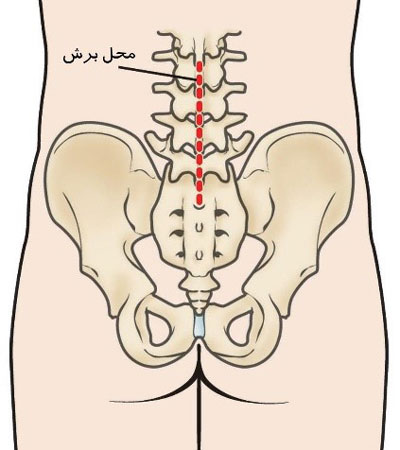 جراحی فیوژن