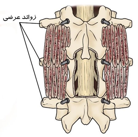 جراحی فیوژن