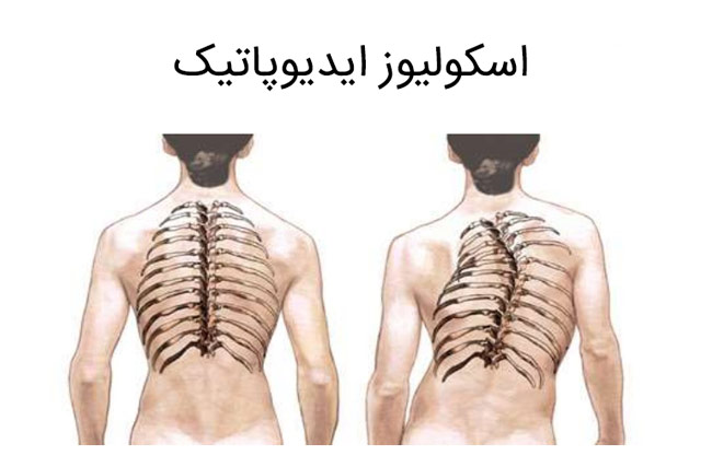 اسکولیوز ایدیوپاتیک