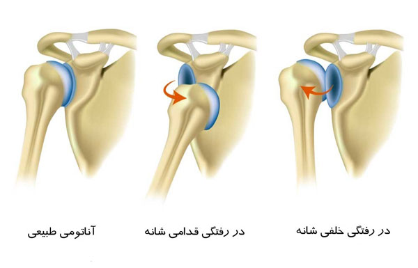 دررفتگی مکرر در مفصل شانه
